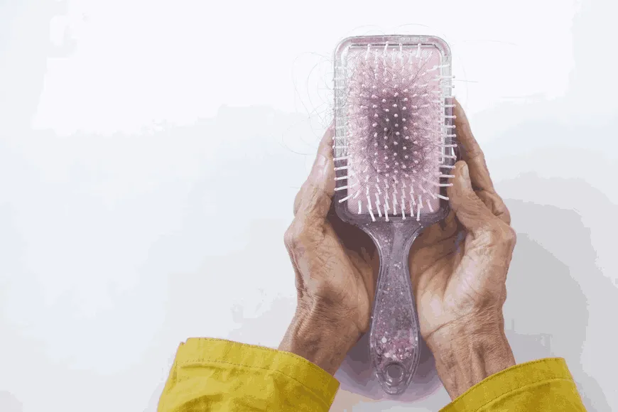 Hairbrush with hair fall showing early signs of hereditary hair loss.