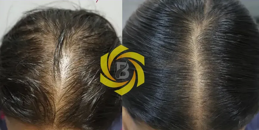 PRP Therpy Results After 6 Months